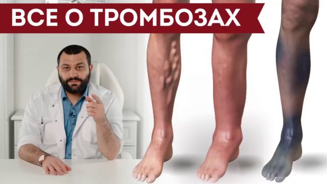 Все? о тромбозах
