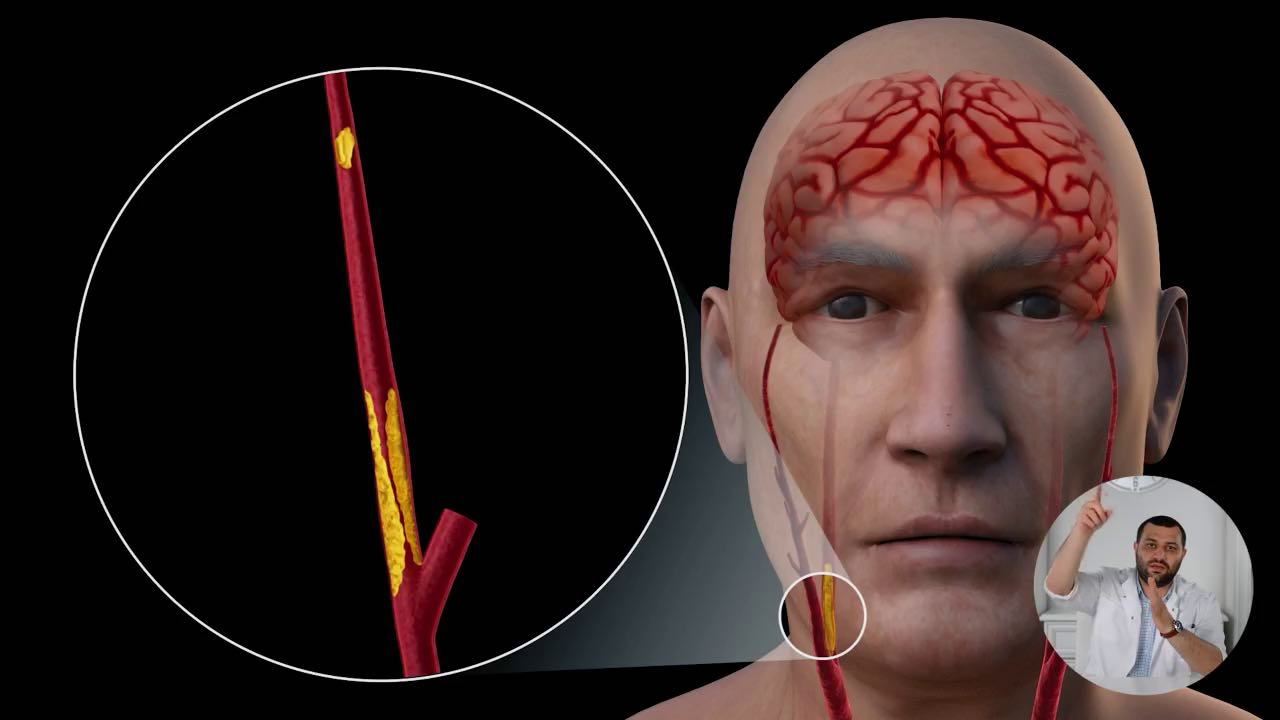 Инсульты. Все, что вам нужно знать